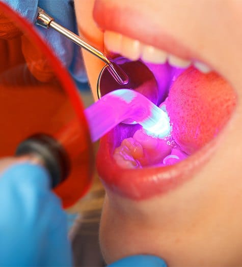 Closeup of patient receiving dental bonding treatment
