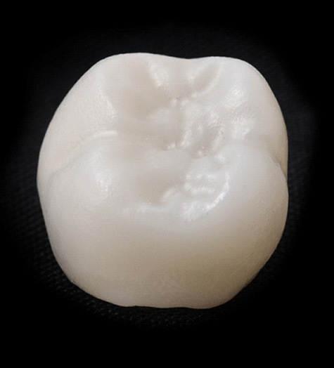 An up-close look at a metal-free dental crown