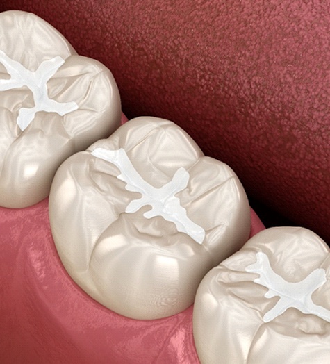 A digital image of tooth-colored fillings along the back teeth