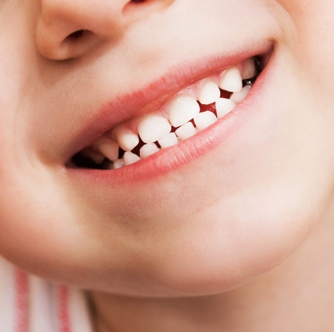 Closeup of smiling child after dental sealant placement