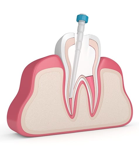 Animated tooth receiving pulp therapy