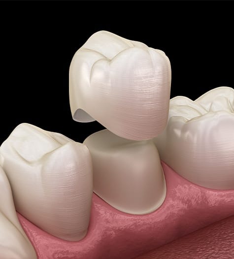 Aniamted dental crown placement