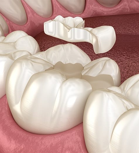 Animated tooth receiving tooth colored filling
