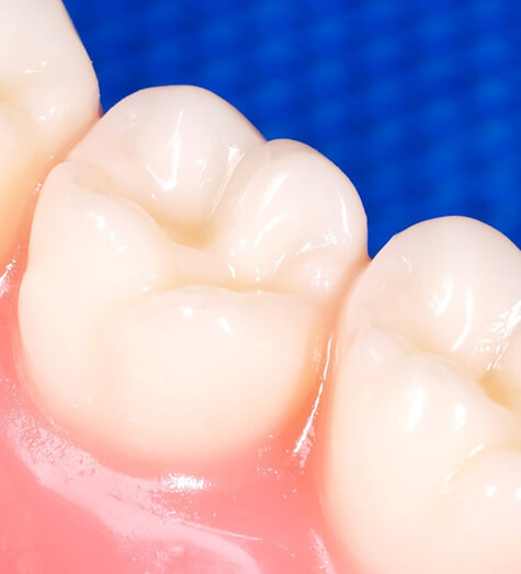 An up-close look at dental molars and their pits and grooves