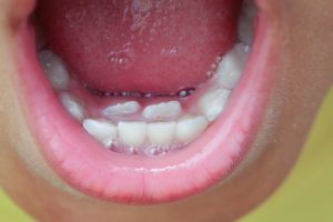 Closeup of child's mouth with baby and adult teeth