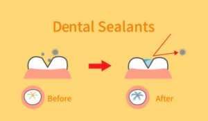 illustration of dental sealants 