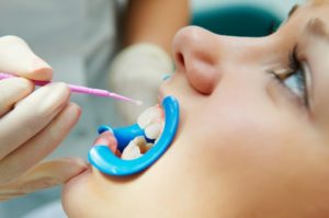 a dentist applying silver diamine fluoride to teeth